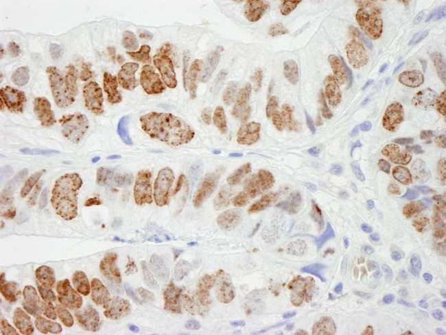 H2AFX / H2AX Antibody - Detection of Human H2AX by Immunohistochemistry. Sample: FFPE section of human colon adenocarcinoma. Antibody: Affinity purified rabbit anti-H2AX used at a dilution of 1:500. Detection: DAB.