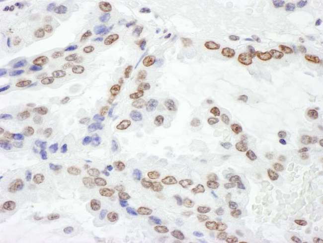 H2AFX / H2AX Antibody - Detection of Human H2AX by Immunohistochemistry. Sample: FFPE section of human lung cancer. Antibody: Affinity purified rabbit anti-H2AX used at a dilution of 1:5000 (0.2 ug/ml). Detection: DAB.