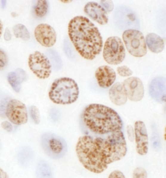 H2AFX / H2AX Antibody - Detection of Mouse H2AX by Immunohistochemistry. Sample: FFPE section of mouse renal cell carcinoma. Antibody: Affinity purified rabbit anti-H2AX used at a dilution of 1:1000 (1 ug/ml). Detection: DAB.