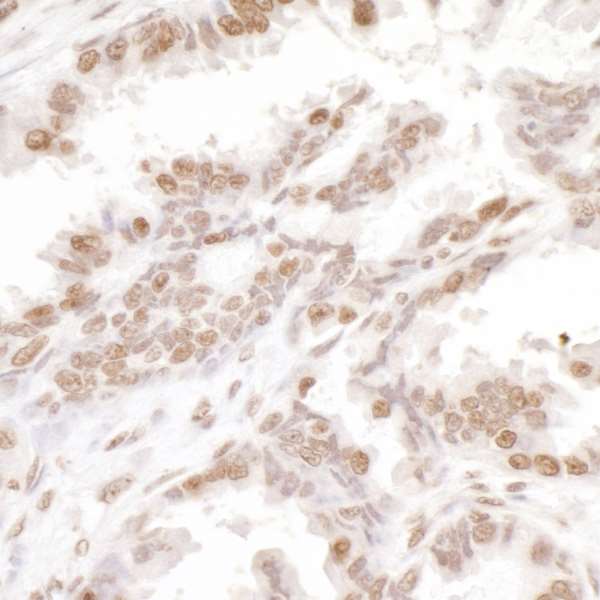 H2AFX / H2AX Antibody - Detection of human H2AX by immunohistochemistry. Sample: FFPE section of human ovarian cancer. Antibody: Affinity purified goat anti- H2AX used at a dilution of 1:5,000 (0.2µg/ml). Detection: DAB