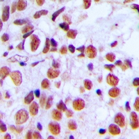 H2AFX / H2AX Antibody - Immunohistochemical analysis of Histone H2A.X (pS139) staining in human breast cancer formalin fixed paraffin embedded tissue section. The section was pre-treated using heat mediated antigen retrieval with sodium citrate buffer (pH 6.0). The section was then incubated with the antibody at room temperature and detected with HRP and DAB as chromogen. The section was then counterstained with hematoxylin and mounted with DPX.