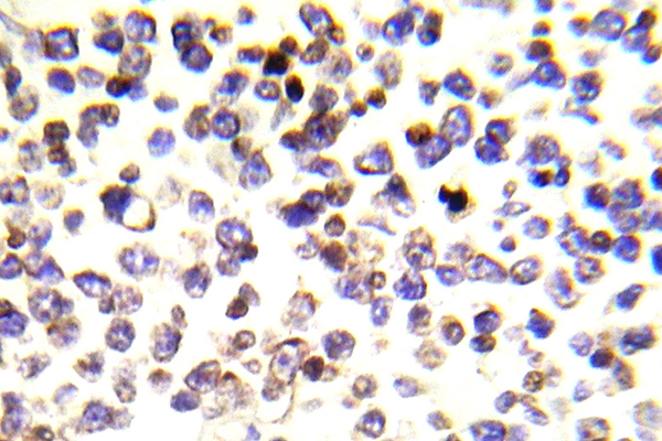 H2AFX / H2AX Antibody - IHC of Histone H2A.X (E145) pAb in paraffin-embedded human malignant lymphoma tissue.
