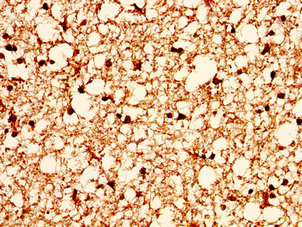H2AFX / H2AX Antibody - Immunohistochemistry image at a dilution of 1:10 and staining in paraffin-embedded human brain tissue performed on a Leica BondTM system. After dewaxing and hydration, antigen retrieval was mediated by high pressure in a citrate buffer (pH 6.0) . Section was blocked with 10% normal goat serum 30min at RT. Then primary antibody (1% BSA) was incubated at 4 °C overnight. The primary is detected by a biotinylated secondary antibody and visualized using an HRP conjugated SP system.