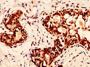 H2AFX / H2AX Antibody - Immunohistochemistry image at a dilution of 1:50 and staining in paraffin-embedded human breast cancer performed on a Leica BondTM system. After dewaxing and hydration, antigen retrieval was mediated by high pressure in a citrate buffer (pH 6.0) . Section was blocked with 10% normal goat serum 30min at RT. Then primary antibody (1% BSA) was incubated at 4 °C overnight. The primary is detected by a biotinylated secondary antibody and visualized using an HRP conjugated SP system.