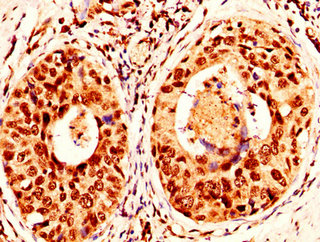 H2AFX / H2AX Antibody - Immunohistochemistry image at a dilution of 1:50 and staining in paraffin-embedded human cervical cancer performed on a Leica BondTM system. After dewaxing and hydration, antigen retrieval was mediated by high pressure in a citrate buffer (pH 6.0) . Section was blocked with 10% normal goat serum 30min at RT. Then primary antibody (1% BSA) was incubated at 4 °C overnight. The primary is detected by a biotinylated secondary antibody and visualized using an HRP conjugated SP system.
