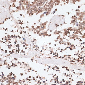 H2AFX / H2AX Antibody - Immunohistochemistry of paraffin-embedded human lung cancer using H2AFX antibody at dilution of 1:100 (40x lens).
