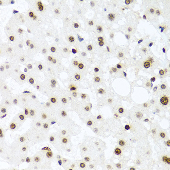 H2AFX / H2AX Antibody - Immunohistochemistry of paraffin-embedded human liver injury using H2AFX antibody at dilution of 1:100 (40x lens).