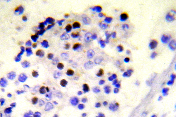 H2AFX / H2AX Antibody - IHC of p-Histone H2A.X (S139) pAb in paraffin-embedded human malignant lymphoma tissue.