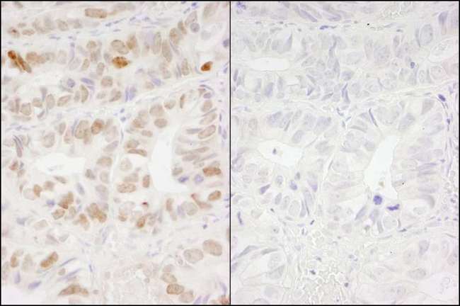 H2AFX / H2AX Antibody - Detection of Human gamma H2AX by Immunohistochemistry. Samples: FFPE serial sections of human colon carcinoma. Mock phosphatase treated section (left) or calf intestinal phosphatase-treated section (right) immunostained for gamma H2AX. Antibody: Affinity purified rabbit anti-gamma H2AX used at a dilution of 1:250.