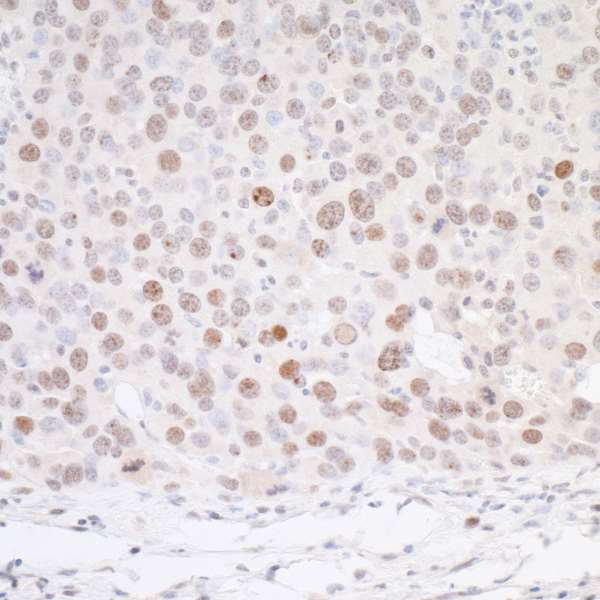H2AFX / H2AX Antibody - Detection of mouse gamma-H2AX by immunohistochemistry. Sample: FFPE section of mouse renal cell carcinoma. Antibody: Affinity purified rabbit anti- gamma-H2AX used at a dilution of 1:5,000 (0.2 µg/ml). Detection: DAB.