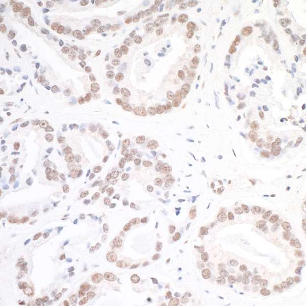 H2AFX / H2AX Antibody - Detection of human gamma-H2AX by immunohistochemistry. Sample: FFPE section of human prostate carcinoma. Antibody: Affinity purified rabbit anti- gamma-H2AX used at a dilution of 1:5,000 (0.2 µg/ml). Detection: DAB.