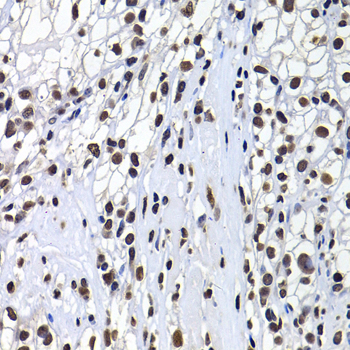 H2AFY / MACROH2A1 Antibody - Immunohistochemistry of paraffin-embedded human kidney cancer tissue.