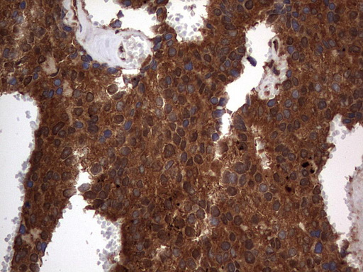 H2AFY2 Antibody - IHC of paraffin-embedded Adenocarcinoma of Human breast tissue using anti-H2AFY2 mouse monoclonal antibody. (Heat-induced epitope retrieval by 1 mM EDTA in 10mM Tris, pH8.5, 120°C for 3min).