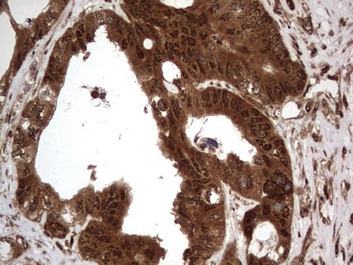 H2AFY2 Antibody - IHC of paraffin-embedded Adenocarcinoma of Human colon tissue using anti-H2AFY2 mouse monoclonal antibody. (Heat-induced epitope retrieval by 1 mM EDTA in 10mM Tris, pH8.5, 120°C for 3min).