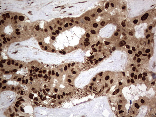 H2AFY2 Antibody - IHC of paraffin-embedded Carcinoma of Human liver tissue using anti-H2AFY2 mouse monoclonal antibody. (Heat-induced epitope retrieval by 1 mM EDTA in 10mM Tris, pH8.5, 120°C for 3min).