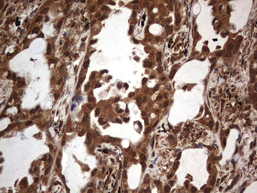 H2AFY2 Antibody - IHC of paraffin-embedded Carcinoma of Human lung tissue using anti-H2AFY2 mouse monoclonal antibody. (Heat-induced epitope retrieval by 1 mM EDTA in 10mM Tris, pH8.5, 120°C for 3min).