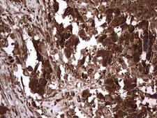 H2AFY2 Antibody - IHC of paraffin-embedded Adenocarcinoma of Human ovary tissue using anti-H2AFY2 mouse monoclonal antibody. (Heat-induced epitope retrieval by 1 mM EDTA in 10mM Tris, pH8.5, 120°C for 3min).
