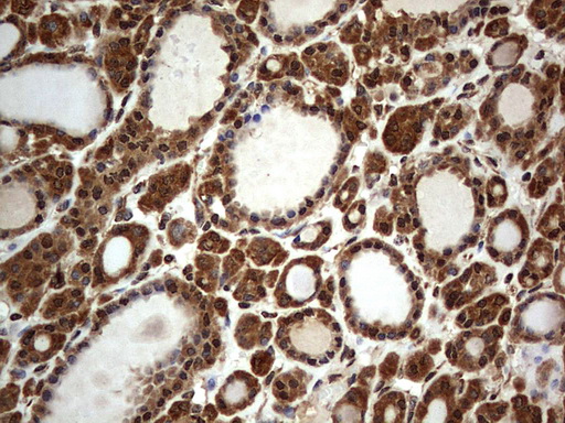 H2AFY2 Antibody - IHC of paraffin-embedded Carcinoma of Human thyroid tissue using anti-H2AFY2 mouse monoclonal antibody. (Heat-induced epitope retrieval by 1 mM EDTA in 10mM Tris, pH8.5, 120°C for 3min).