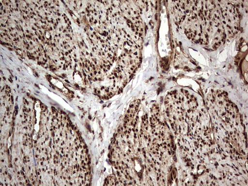 H2AFY2 Antibody - IHC of paraffin-embedded Adenocarcinoma of Human endometrium tissue using anti-H2AFY2 mouse monoclonal antibody. (Heat-induced epitope retrieval by 1 mM EDTA in 10mM Tris, pH8.5, 120°C for 3min).
