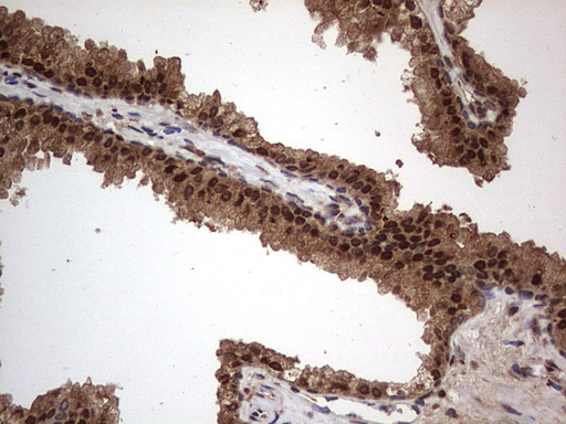H2AFY2 Antibody - IHC of paraffin-embedded Carcinoma of Human prostate tissue using anti-H2AFY2 mouse monoclonal antibody. (Heat-induced epitope retrieval by 1 mM EDTA in 10mM Tris, pH8.5, 120°C for 3min).