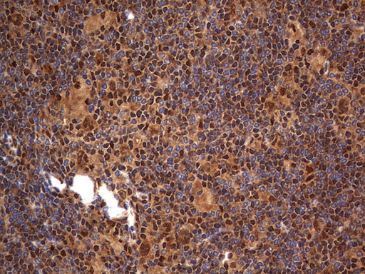 H2AFY2 Antibody - IHC of paraffin-embedded Human lymphoma tissue using anti-H2AFY2 mouse monoclonal antibody. (Heat-induced epitope retrieval by 1 mM EDTA in 10mM Tris, pH8.5, 120°C for 3min).