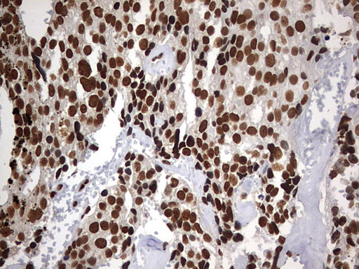 H2AFY2 Antibody - IHC of paraffin-embedded Adenocarcinoma of Human breast tissue using anti-H2AFY2 mouse monoclonal antibody. (Heat-induced epitope retrieval by 10mM citric buffer, pH6.0, 120°C for 3min).