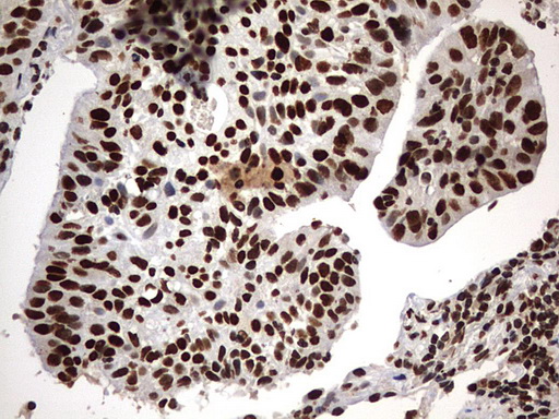 H2AFY2 Antibody - IHC of paraffin-embedded Carcinoma of Human lung tissue using anti-H2AFY2 mouse monoclonal antibody. (Heat-induced epitope retrieval by 10mM citric buffer, pH6.0, 120°C for 3min).