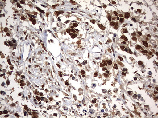 H2AFY2 Antibody - IHC of paraffin-embedded Adenocarcinoma of Human ovary tissue using anti-H2AFY2 mouse monoclonal antibody. (Heat-induced epitope retrieval by 10mM citric buffer, pH6.0, 120°C for 3min).