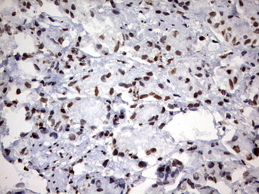 H2AFY2 Antibody - IHC of paraffin-embedded Carcinoma of Human prostate tissue using anti-H2AFY2 mouse monoclonal antibody. (Heat-induced epitope retrieval by 10mM citric buffer, pH6.0, 120°C for 3min).
