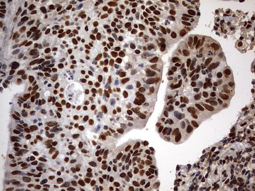H2AFY2 Antibody - IHC of paraffin-embedded Carcinoma of Human lung tissue using anti-H2AFY2 mouse monoclonal antibody. (Heat-induced epitope retrieval by 10mM citric buffer, pH6.0, 120°C for 3min).