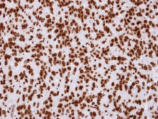 H2AFZ / H2A.z Antibody - IHC of paraffin-embedded ES-2 xenograft using Histone H2A.Z antibody at 1:100 dilution.