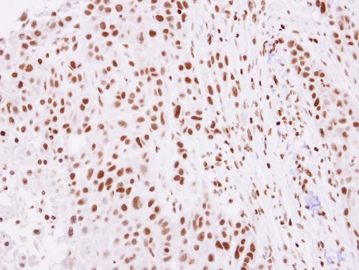 H2AFZ / H2A.z Antibody - IHC of paraffin-embedded SCC4 xenograft using Histone H2A.Z antibody at 1:100 dilution.