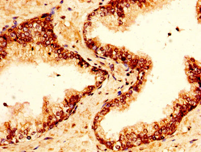 H2AFZ / H2A.z Antibody - Immunohistochemistry image at a dilution of 1:20 and staining in paraffin-embedded human prostate tissue performed on a Leica BondTM system. After dewaxing and hydration, antigen retrieval was mediated by high pressure in a citrate buffer (pH 6.0) . Section was blocked with 10% normal goat serum 30min at RT. Then primary antibody (1% BSA) was incubated at 4 °C overnight. The primary is detected by a biotinylated secondary antibody and visualized using an HRP conjugated SP system.