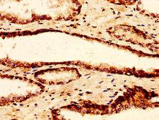 H2AFZ / H2A.z Antibody - Immunohistochemistry image at a dilution of 1:30 and staining in paraffin-embedded human prostate tissue performed on a Leica BondTM system. After dewaxing and hydration, antigen retrieval was mediated by high pressure in a citrate buffer (pH 6.0) . Section was blocked with 10% normal goat serum 30min at RT. Then primary antibody (1% BSA) was incubated at 4 °C overnight. The primary is detected by a biotinylated secondary antibody and visualized using an HRP conjugated SP system.