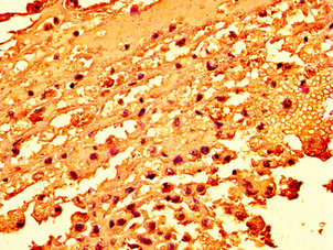 H2AFZ / H2A.z Antibody - Immunohistochemistry image at a dilution of 1:50 and staining in paraffin-embedded human melanoma cancer performed on a Leica BondTM system. After dewaxing and hydration, antigen retrieval was mediated by high pressure in a citrate buffer (pH 6.0) . Section was blocked with 10% normal goat serum 30min at RT. Then primary antibody (1% BSA) was incubated at 4 °C overnight. The primary is detected by a biotinylated secondary antibody and visualized using an HRP conjugated SP system.