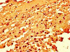 H2AFZ / H2A.z Antibody - Immunohistochemistry image at a dilution of 1:50 and staining in paraffin-embedded human melanoma cancer performed on a Leica BondTM system. After dewaxing and hydration, antigen retrieval was mediated by high pressure in a citrate buffer (pH 6.0) . Section was blocked with 10% normal goat serum 30min at RT. Then primary antibody (1% BSA) was incubated at 4 °C overnight. The primary is detected by a biotinylated secondary antibody and visualized using an HRP conjugated SP system.