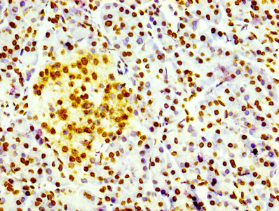 H3F3B Antibody - Immunohistochemistry Dilution at 1:100 and staining in paraffin-embedded human pancreatic tissue performed on a Leica BondTM system. After dewaxing and hydration, antigen retrieval was mediated by high pressure in a citrate buffer (pH 6.0). Section was blocked with 10% normal Goat serum 30min at RT. Then primary antibody (1% BSA) was incubated at 4°C overnight. The primary is detected by a biotinylated Secondary antibody and visualized using an HRP conjugated SP system.