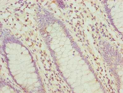 HABP2 Antibody - Immunohistochemistry of paraffin-embedded human colon cancer using HABP2 Antibody at dilution of 1:100