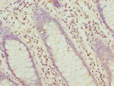 HABP2 Antibody - Immunohistochemistry of paraffin-embedded human colon cancer using HABP2 Antibody at dilution of 1:100