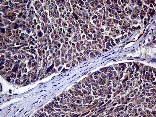 HABP2 Antibody - Immunohistochemical staining of paraffin-embedded Carcinoma of Human liver tissue using anti-HABP2 mouse monoclonal antibody. (Heat-induced epitope retrieval by 1mM EDTA in 10mM Tris buffer. (pH8.5) at 120°C for 3 min. (1:1000)
