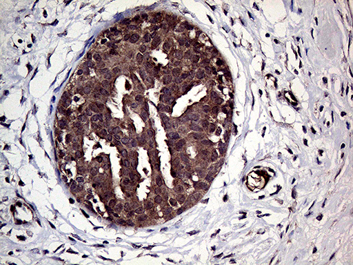 HABP2 Antibody - Immunohistochemical staining of paraffin-embedded Human breast tissue within the normal limits using anti-HABP2 mouse monoclonal antibody. (Heat-induced epitope retrieval by 1mM EDTA in 10mM Tris buffer. (pH8.5) at 120°C for 3 min. (1:1000)