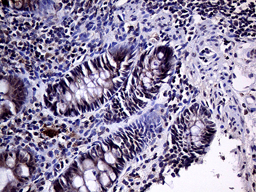 HABP2 Antibody - Immunohistochemical staining of paraffin-embedded Human colon tissue within the normal limits using anti-HABP2 mouse monoclonal antibody. (Heat-induced epitope retrieval by 1mM EDTA in 10mM Tris buffer. (pH8.5) at 120°C for 3 min. (1:1000)
