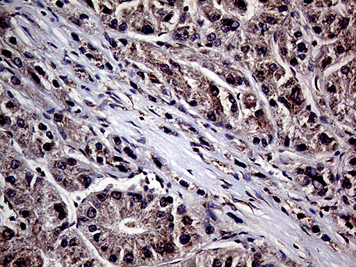 HABP2 Antibody - Immunohistochemical staining of paraffin-embedded Human liver tissue within the normal limits using anti-HABP2 mouse monoclonal antibody. (Heat-induced epitope retrieval by 1mM EDTA in 10mM Tris buffer. (pH8.5) at 120°C for 3 min. (1:1000)