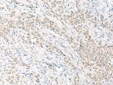 HABP4 Antibody - Immunohistochemistry of paraffin-embedded Human ovarian cancer tissue  using HABP4 Polyclonal Antibody at dilution of 1:60(×200)