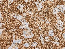 HABP4 Antibody - Immunohistochemistry of paraffin-embedded Human ovarian cancer tissue  using HABP4 Polyclonal Antibody at dilution of 1:55(×200)