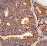HACD2 / PTPLB Antibody - PTPLB Antibody immunohistochemistry of formalin-fixed and paraffin-embedded human prostate carcinoma followed by peroxidase-conjugated secondary antibody and DAB staining.