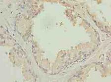 HACD2 / PTPLB Antibody - Immunohistochemistry of paraffin-embedded human prostate cancer using antibody at dilution of 1:100.