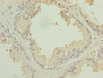 HACD2 / PTPLB Antibody - Immunohistochemistry of paraffin-embedded human prostate cancer using HACD2 Antibody at dilution of 1:100