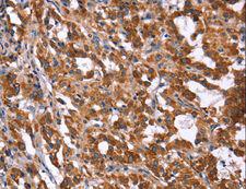 HACE1 Antibody - Immunohistochemistry of paraffin-embedded Human gastric cancer using HACE1 Polyclonal Antibody at dilution of 1:40.