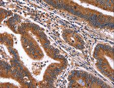 HACE1 Antibody - Immunohistochemistry of paraffin-embedded Human ovarian cancer using HACE1 Polyclonal Antibody at dilution of 1:50.